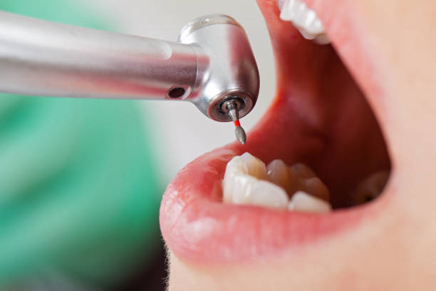 Best Emergency Wisdom Teeth Removal in Hampton, IA